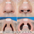 LivZuri Nasal Dilators