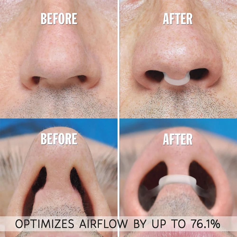 LivZuri Nasal Dilators